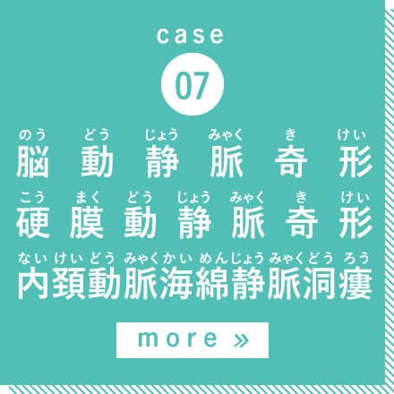 case07 脳動静脈奇形・硬膜動静脈奇形・内頚動脈海綿静脈洞瘻 more